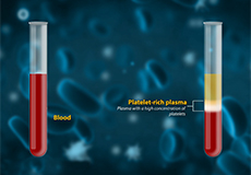 Platelet-Rich Plasma (PRP) Injection