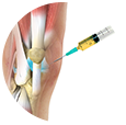 Platelet-Rich Plasma (PRP) Injection