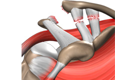 Massive Retracted Rotator Cuff Tear  Advanced Orthopaedics & Sports  Medicine, Orthopaedic Specialists, Cypress, Houston, TX